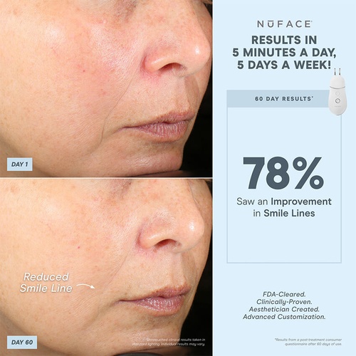 NUFACE NuFACE Trinity+® Effective Lip & Eye Attachment » buy