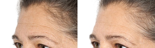 perricone md acyl glutathione deep crease serum reviews APR-246 induces early cell death by ferroptosis in acute myeloid leukemia main image 1