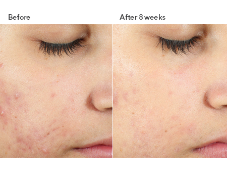 INVISISCAR™ RESURFACING TREATMENT