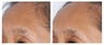 U Beauty Resurfacing Flash Peel
