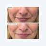 111Skin Precision Peel